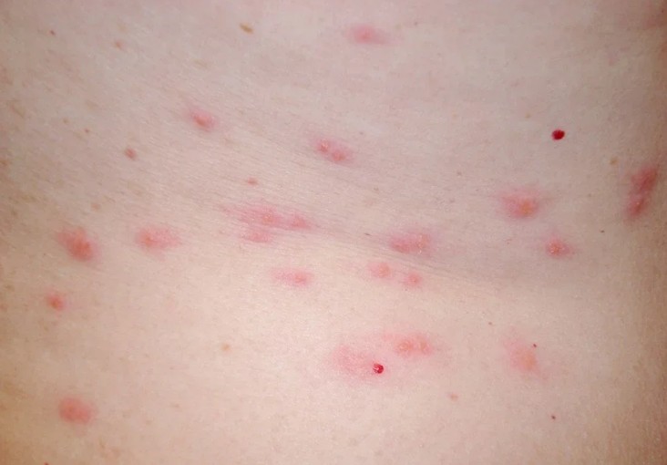 Bed Bug Bites